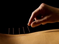 Pessoa recebendo acupuntura para tratar hérnia de disco