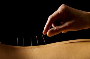Pessoa recebendo acupuntura para tratar hérnia de disco
